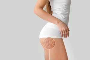 Young woman with cellulite problem