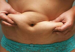 how to avoid a tummy tuck