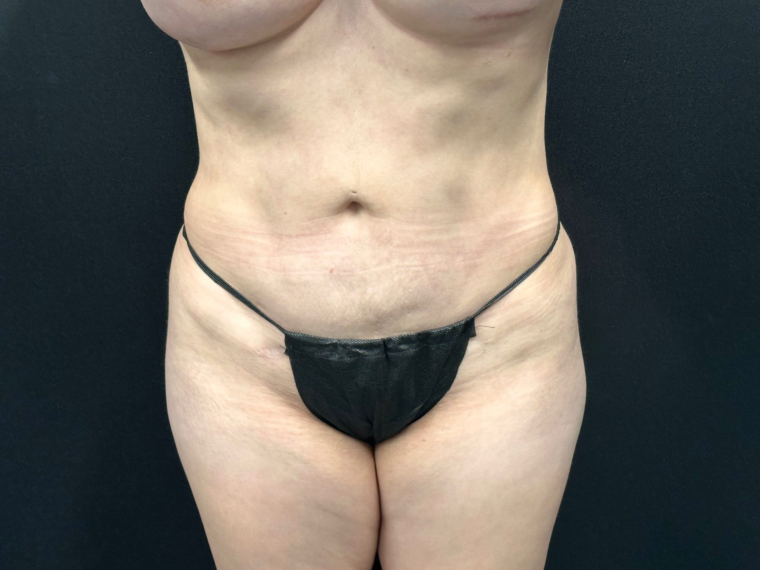 Tummy Tuck Charlotte NC - Charlotte Plastic Surgery
